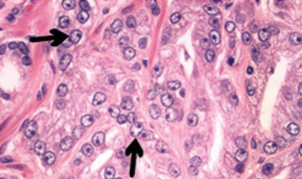 Prostate Cancer Focal Therapy